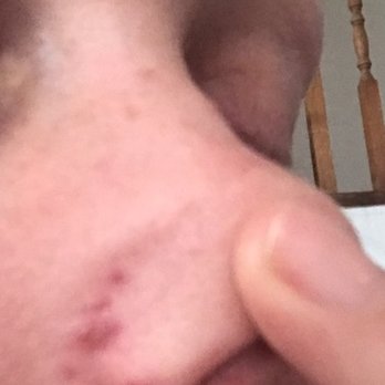 Evaluer Medspa - Laser burns that left permanent red marks after treatment by Julie - Medical Spas Near Me - Lafayette, California