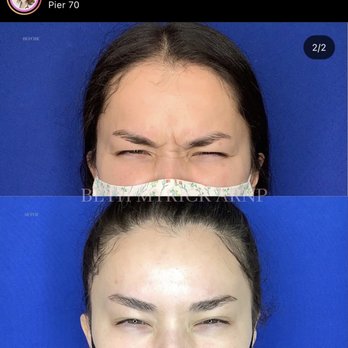 Bellora Medical Aesthetics - Crows feet and between brows before and after - Skin Care Near Me - Seattle, Washington Bellora Medical Aesthetics - Crows feet and between brows before and after - Skin Care Near Me - Seattle, Washington