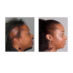 Bosley Hair Restoration & Transplant - Permanent hair restoration (hair transplantation) by Bosley