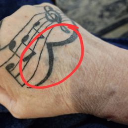 At first I thought this was bruising. Once it healed it's not, it's blow out. **disappointed!! At first I thought this was bruising. Once it healed it's not, it's blow out. **disappointed!!