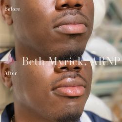 Bellora Medical Aesthetics - Male Lip Filler