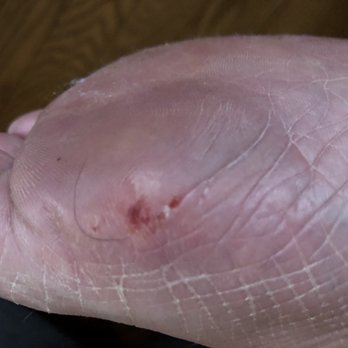 Coco Nails - Bleeding foot from pedicure - Nail Salons Near Me - East Rutherford, New Jersey
