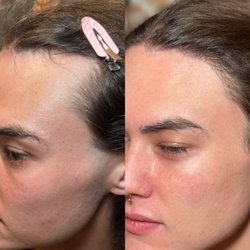 Enfuse Medical Spa - Hair transplant