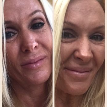 Solea Ageless Beauty - Before May.... After (present) - Aestheticians Near Me - Holbrook, Massachusetts Solea Ageless Beauty - Before May.... After (present) - Aestheticians Near Me - Holbrook, Massachusetts