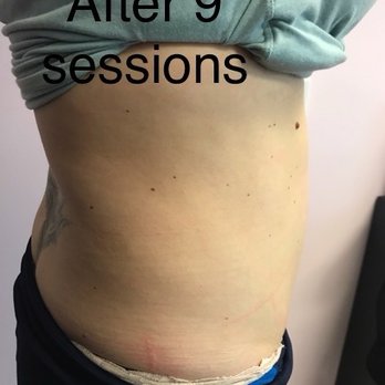 Eye Candy Body Sculpting - After 9 sessions - Body Contouring Near Me - Corona, California