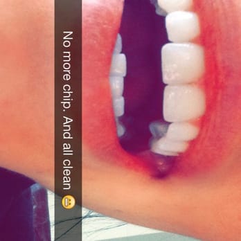 Alex Rader, DDS - Front, right, top tooth had a pretty big chip in it--not that you'd ever know that now! Thanks Dr. Rader. - Cosmetic Dentists Near Me - Walnut Creek, California