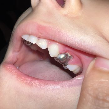 Scott Fishman, DDS - The crown that looks fine. - Pediatric Dentists Near Me - Downey, California Scott Fishman, DDS - The crown that looks fine. - Pediatric Dentists Near Me - Downey, California