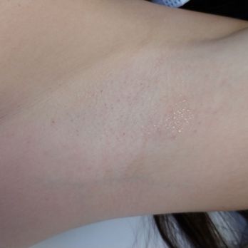 Glow Medspa - Colleyville - two months since body hair does not grow.  very happy - Laser Hair Removal Near Me - Colleyville, Texas