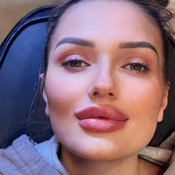 J W Aesthetic - After lip filler.