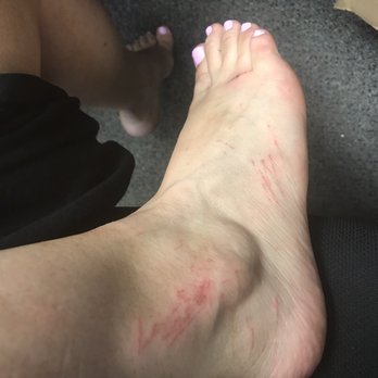 Happy Nails and Spa - Another photo of my infected feet. - Nail Salons Near Me - Aliso Viejo, California Happy Nails and Spa - Another photo of my infected feet. - Nail Salons Near Me - Aliso Viejo, California