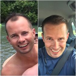 McGrath Medical - Before and after McgrathMedical hair transplant