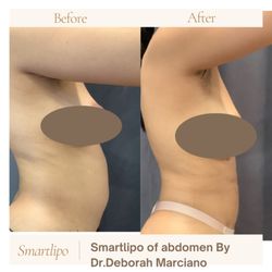 Great Neck Medical Spa - Smartlipo liposuction