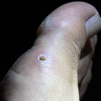 Blue Diamond Nails Spa - 2 weeks later and it's still scabbed up and sore as fuck - Nail Salons Near Me - Enterprise, Nevada Blue Diamond Nails Spa - 2 weeks later and it's still scabbed up and sore as fuck - Nail Salons Near Me - Enterprise, Nevada