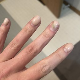 Nail bacteria Nail bacteria