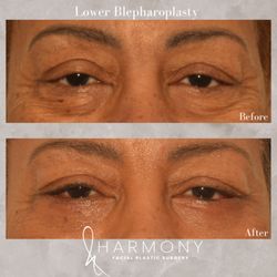 Harmony Facial Plastic Surgery- Dr. Kate O'Connor - Lower blepharoplasty or lower eyelid lift addresses rid of bags, extra skin, and darkness