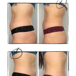 Afterglo Beauty - Cryoslimming Results