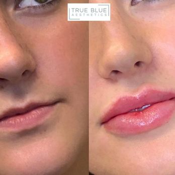 True Blue Aesthetics - Medical Spas Near Me - Edmond, Oklahoma True Blue Aesthetics - Medical Spas Near Me - Edmond, Oklahoma
