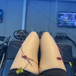 Athleticare Physical Therapy & Sports Performance - Dry needling to relive the tight facia compressing nerves, and day to day pains