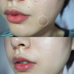 Akoya Aesthetics & Wellness - Acne treatment before & after