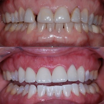 Genuine Family Dentistry - Before and after Veneers - Cosmetic Dentists Near Me - Orange, California Genuine Family Dentistry - Before and after Veneers - Cosmetic Dentists Near Me - Orange, California