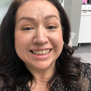 Simply Orthodontics - Right before my braces came off! - Orthodontists Near Me - Irvine, California