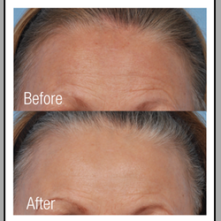 Face Rx Medspa - Pelleve Skin Tightening