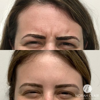 Norah Clair Aesthetics - No more frown with Botox/Dysport! - Medical Spas Near Me - Washington, DC, District of Columbia Norah Clair Aesthetics - No more frown with Botox/Dysport! - Medical Spas Near Me - Washington, DC, District of Columbia