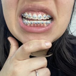 Nolan Smiles Orthodontics - Day 1 with braces