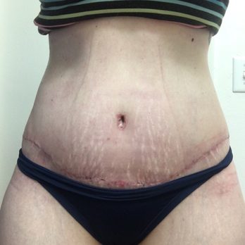 Payam Jarrah - 3 weeks post op. Super low scar and thin scar! - Cosmetic Surgeons Near Me
