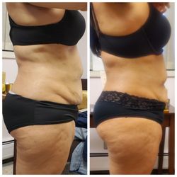SpaLyfe - Before and After 10 Radio Frequency Body Contouring Sessions.