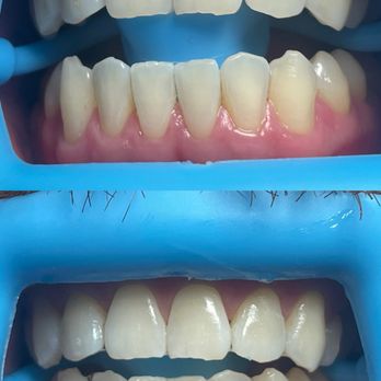 Smile Glo Studio - Before and after - Teeth Whitening Near Me - Covina, California Smile Glo Studio - Before and after - Teeth Whitening Near Me - Covina, California
