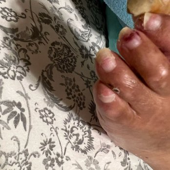 Doc On The Run - Left foot of Dementia patient with overgrown toenails and bruising. - Podiatrists Near Me - San Francisco, California Doc On The Run - Left foot of Dementia patient with overgrown toenails and bruising. - Podiatrists Near Me - San Francisco, California