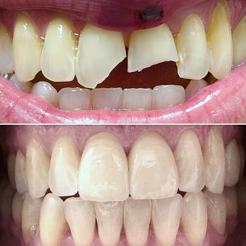 Arturo Aceituno, DMD - Broken maxillary centrals as a result from falling on the pickleball court. Restored with Emax porcelain crowns. - General Dentistry Near Me - Miami, Florida Arturo Aceituno, DMD - Broken maxillary centrals as a result from falling on the pickleball court. Restored with Emax porcelain crowns. - General Dentistry Near Me - Miami, Florida