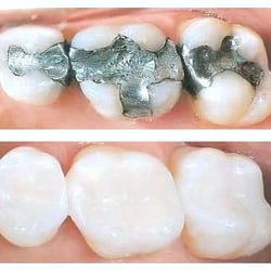 Enhance Dental - Before and After of White Fillings and Porcelain Crowns