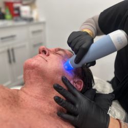 Exion clear to target reds and brown spots at Euphoria Med Spa Rancho Cucamonga