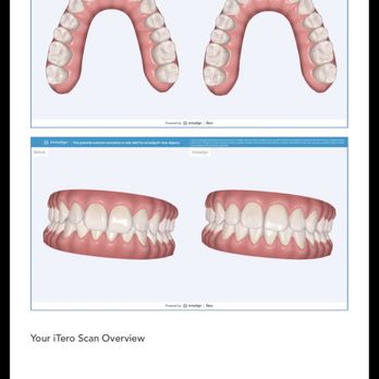 ABC Dental Group - Before and after for Invisalign - Oral Surgeons Near Me - Antioch, California ABC Dental Group - Before and after for Invisalign - Oral Surgeons Near Me - Antioch, California