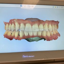 Okun Dentistry Tempe - Amazing service and care for my aligners!