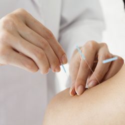 Acupuncture for Neck Pain, Stiff Neck, Pinched Nerve, Shoulder Pain, Frozen Shoulder