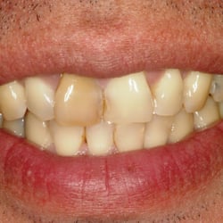 Ashish C Patel, DDS - Before: Stained, old crowns