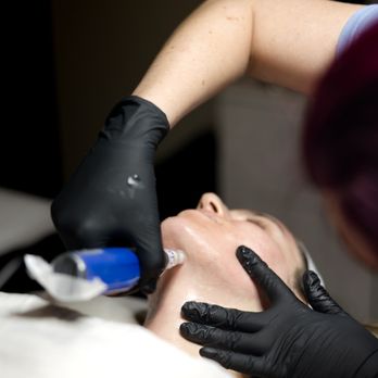 Amazon Aesthetics and Laser - SkinPen Microneedling on the jaw and neck - Estheticians Near Me - Frisco, Texas Amazon Aesthetics and Laser - SkinPen Microneedling on the jaw and neck - Estheticians Near Me - Frisco, Texas