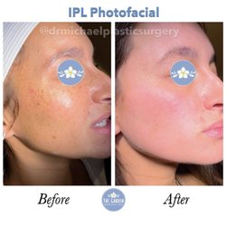 The Garden Medical Spa - IPL Photofacial