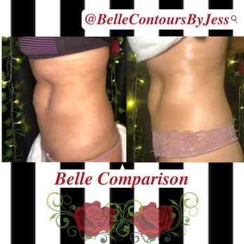 Belle Contours By Jess - After only 45 minutes of UltraCavi + Radio Frequency - Body Contouring Near Me Belle Contours By Jess - After only 45 minutes of UltraCavi + Radio Frequency - Body Contouring Near Me