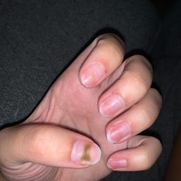 The day I removed the acrylics The day I removed the acrylics