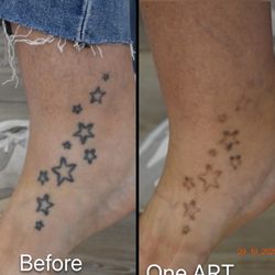5 months results after only one ART treatment