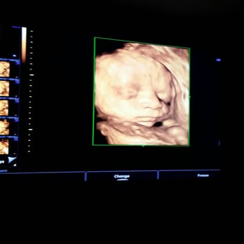 Ultrasona - One of our 3 Xtra-large 75 inch HD Viewing Screens - Diagnostic Imaging Near Me - Lewis Center, Ohio