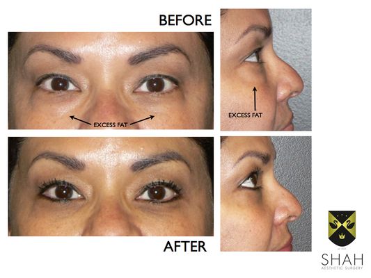 Shah Aesthetic Surgery - Rhinoplasty and Facelift Specialist by null