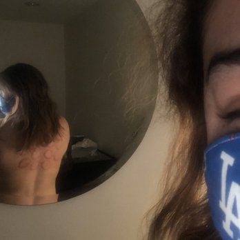 Innova Wellness - Cupping - Acupuncture Near Me - Glendale, California Innova Wellness - Cupping - Acupuncture Near Me - Glendale, California
