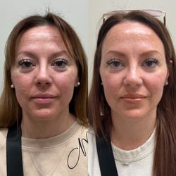 The Beauty Lab Medical Aesthetics - Before on left, 2 week follow up on right. Saw results in 2 days.