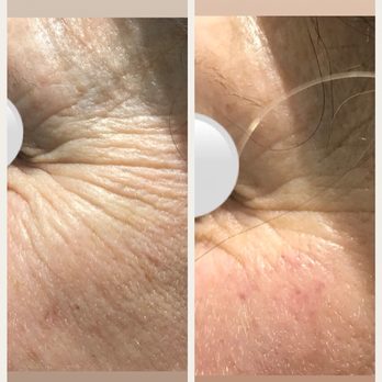 MaBe Skincare - VENUS LEGACY/FACE LIFTING - Medical Spas Near Me - Weston, Florida MaBe Skincare - VENUS LEGACY/FACE LIFTING - Medical Spas Near Me - Weston, Florida