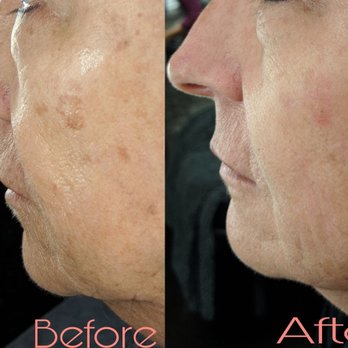 Morpheyourself - Fibroblasting - Eyelash Service Near Me - Whittier, California Morpheyourself - Fibroblasting - Eyelash Service Near Me - Whittier, California